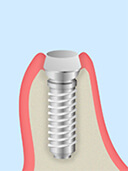 抜歯即時インプラント治療03